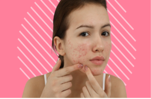 Cystic acne