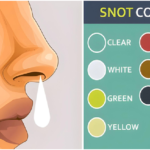 Nasal Discharge